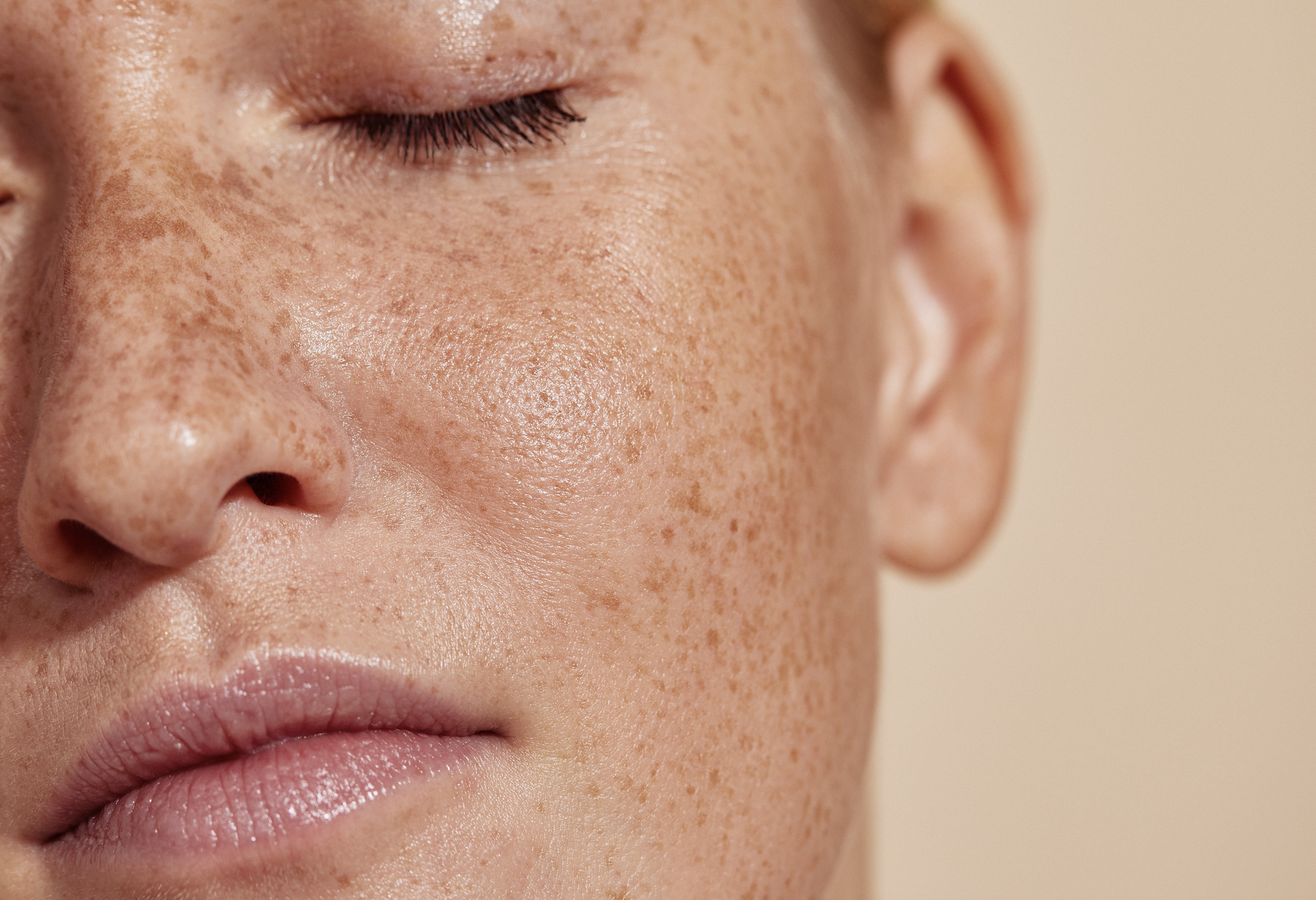 RF Microneedling for Scarring, Lines and Skin Tightening